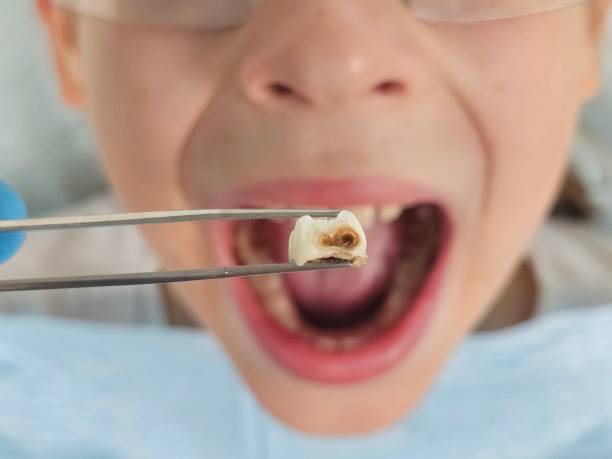 Best Emergency Tooth Extraction in Cupertino, CA